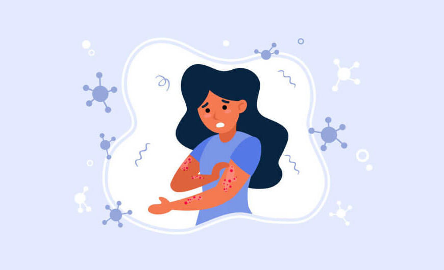 Chronic Skin Disorders