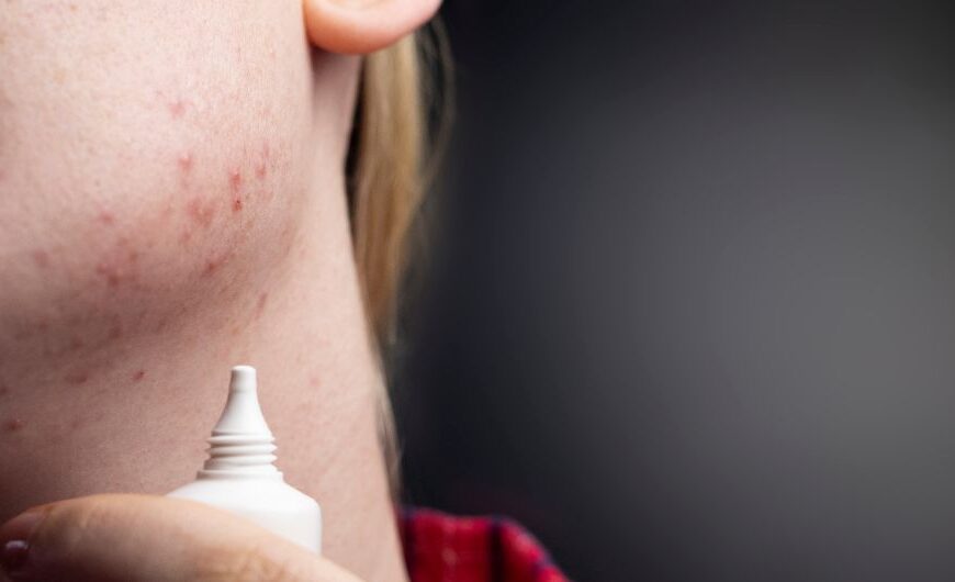 Blemishes and Freckles Home Remedies