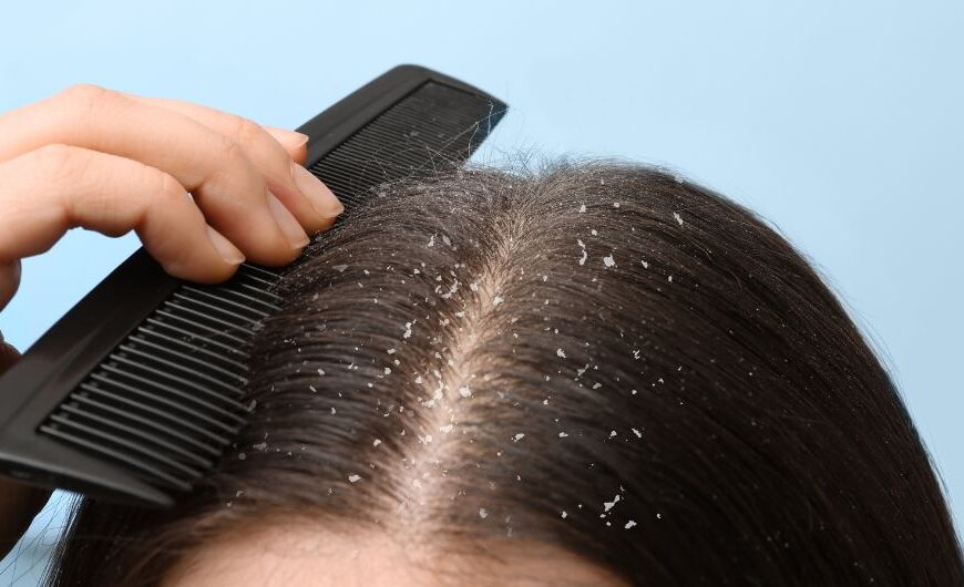 Dandruff Home Remedies