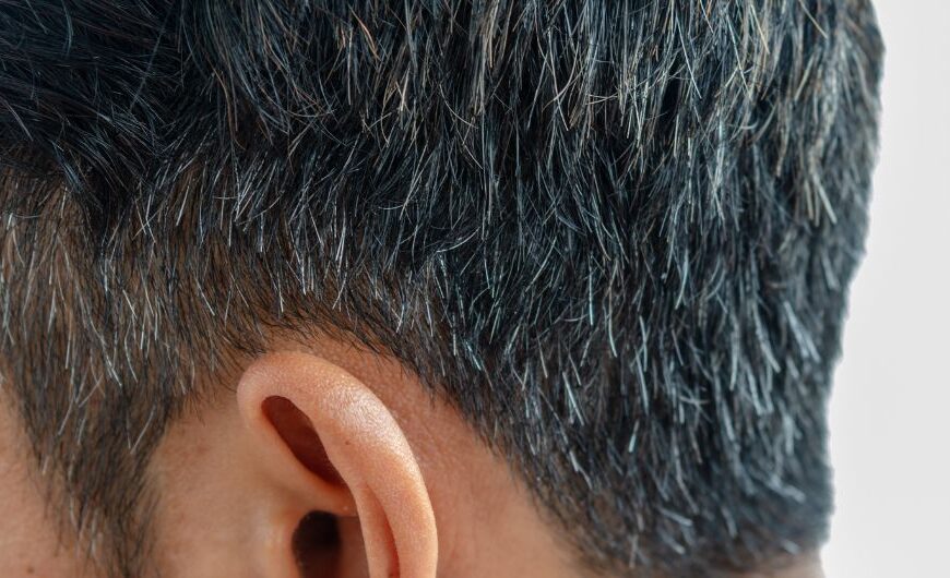 Premature graying of hair