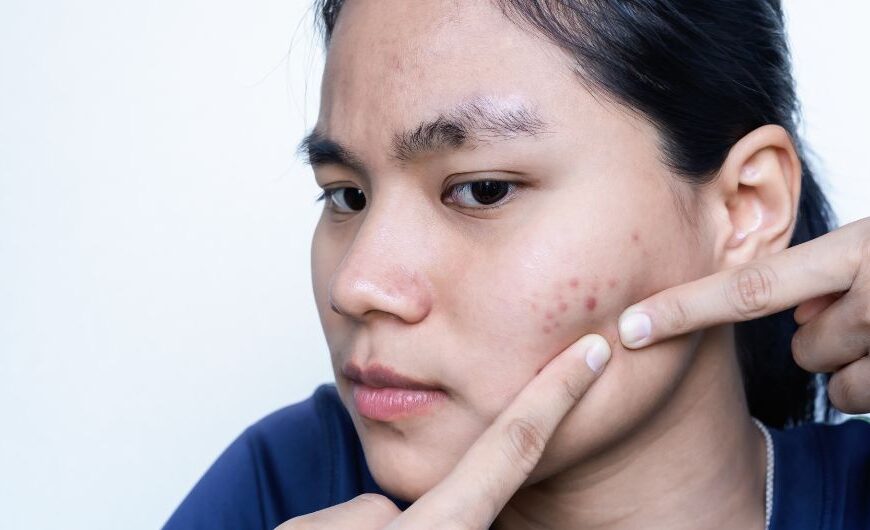 Home Remedies For Pimples