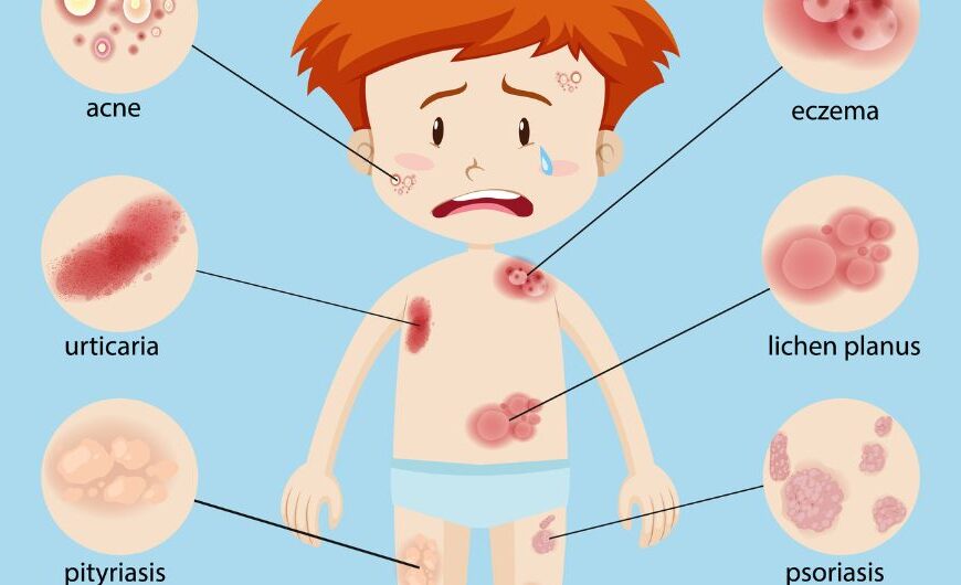 Skin Disorder by Ayurveda
