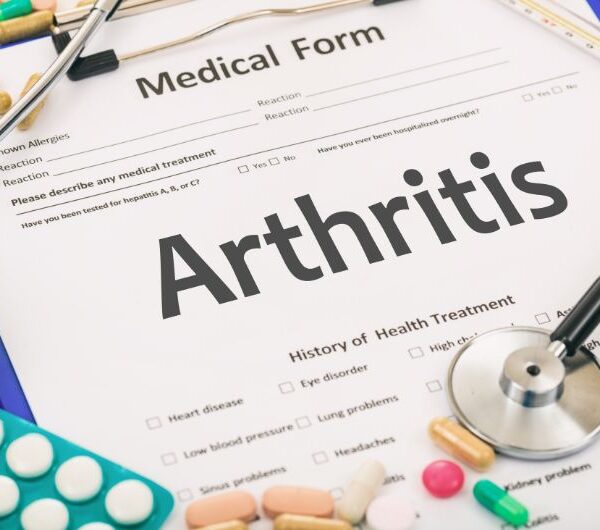 Home Remedies to Decrease Arthritis Impact