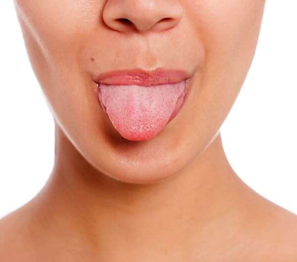 Ayurveda Tongue Diagnosis Based on Tri Doshas