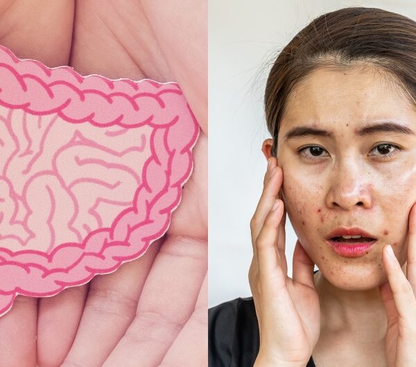 You Can’t Heal Your Skin Without Fixing Your Gut