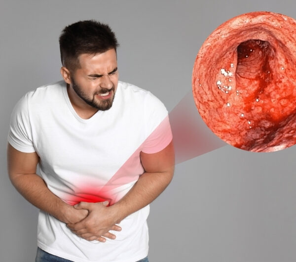 How Hidden Mold Causes Bowel Disease