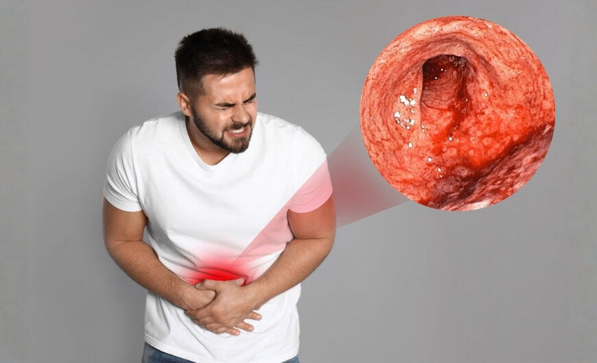 How Hidden Mold Causes Bowel Disease