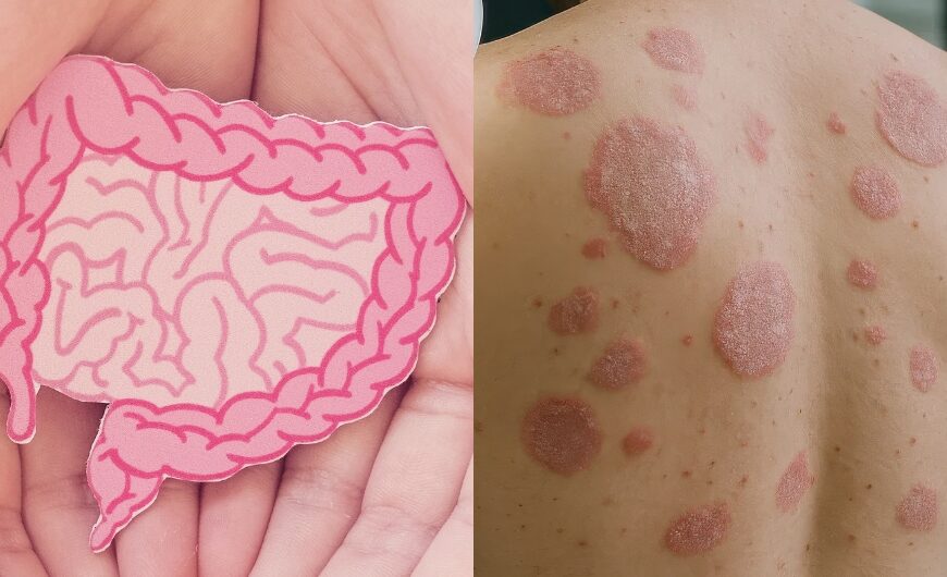 You Can’t Fix Your Skin Until You Fix Your Gut